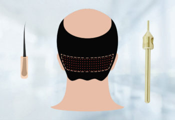 Hair Transplant Fue Gold Technique