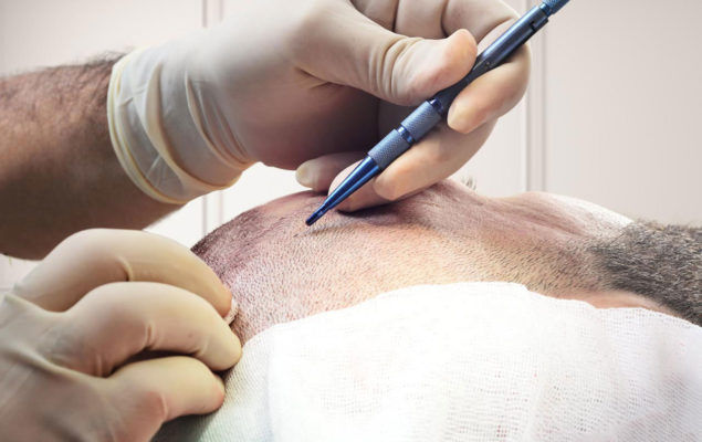 Hair Transplant Sapphire Method