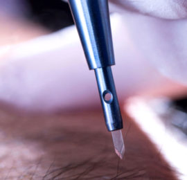 Hair Transplant Sapphire Method